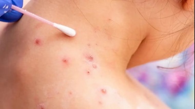 Detectan 10 nuevos casos de viruela del mono en Argentina
