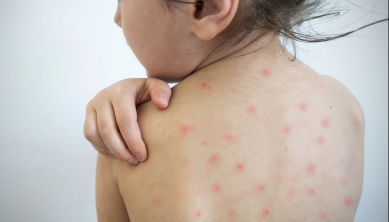Alerta sanitaria por sarampión: una familia no vacunada recorrió ocho jurisdicciones y activó un operativo nacional